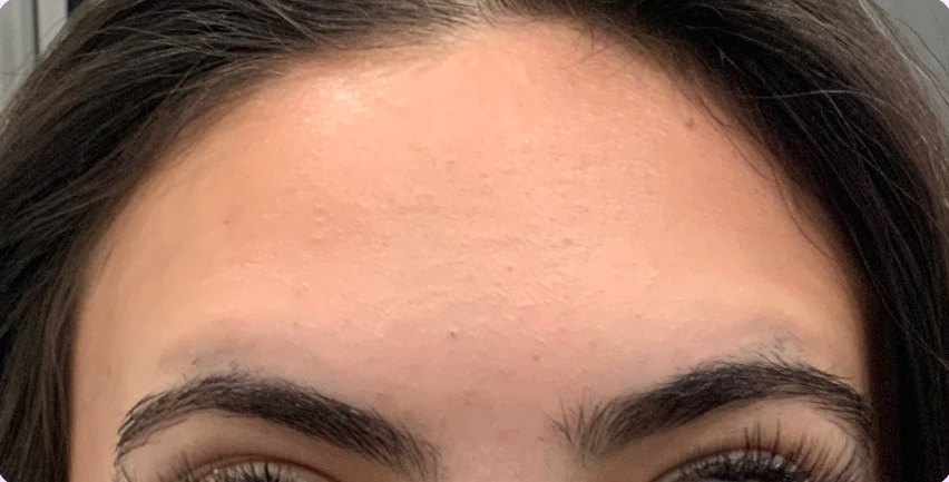 Botox & Dysport · forehead lines after