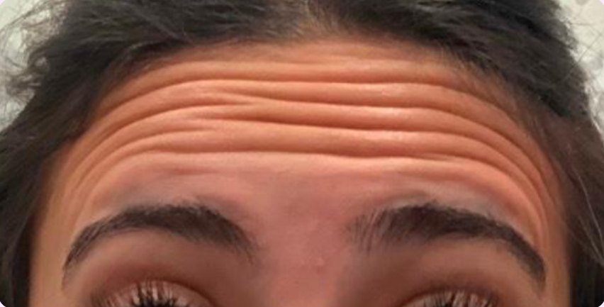 Botox & Dysport · forehead lines before