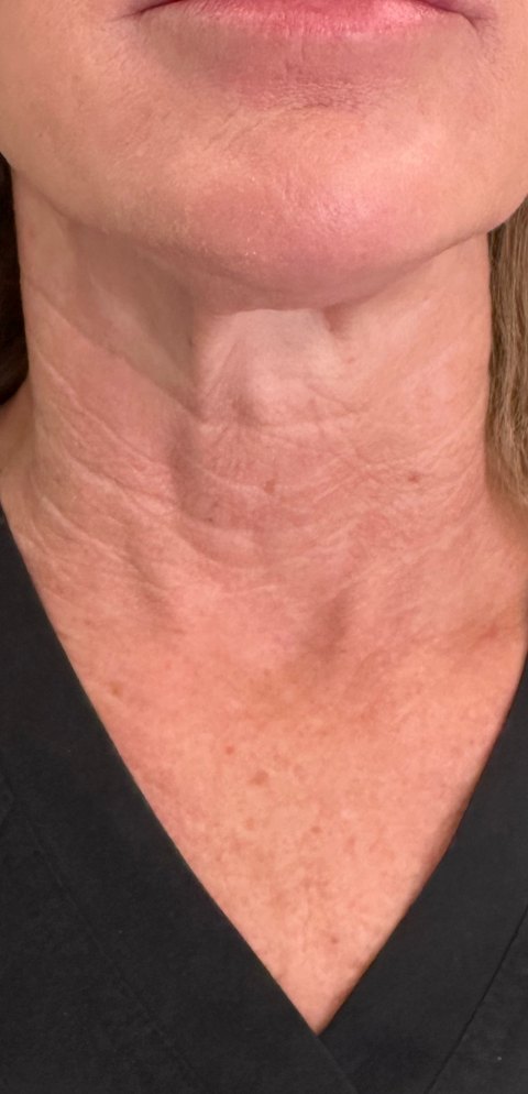 Botox & Dysport · neck lines after