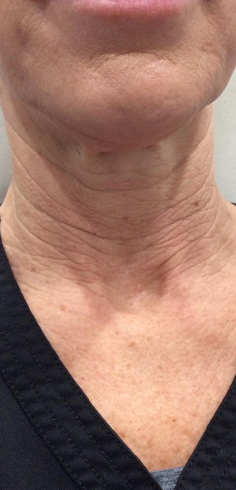 Botox & Dysport · neck lines before