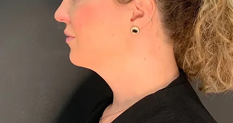 After chin filler — profile with improved chin projection