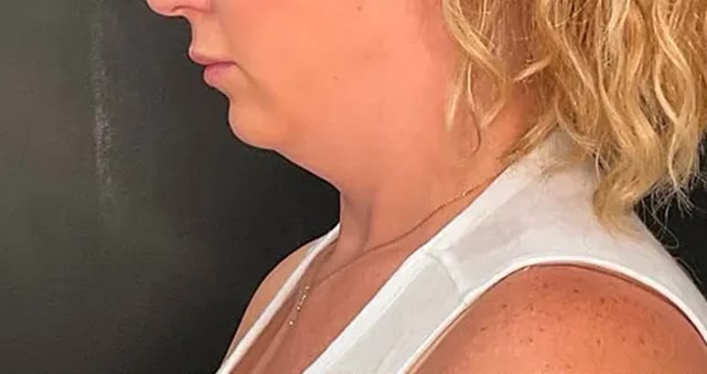 Before chin filler — profile view