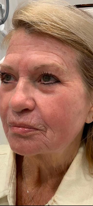 After CO₂ laser resurfacing — smoother facial skin texture