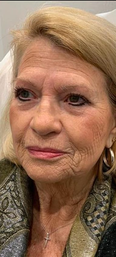 Before CO₂ laser resurfacing — facial skin texture and lines