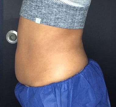 After CoolSculpting Elite — abdomen, side view