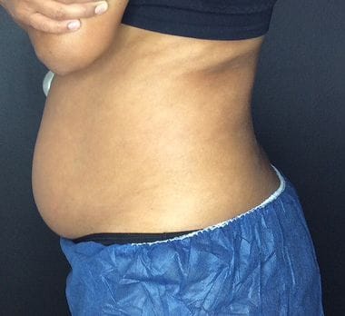 Before CoolSculpting Elite — abdomen, side view