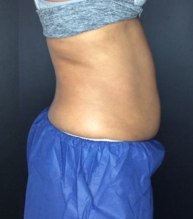 After CoolSculpting Elite — flank and lower abdomen, side view