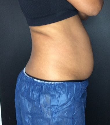 Before CoolSculpting Elite — flank and lower abdomen, side view