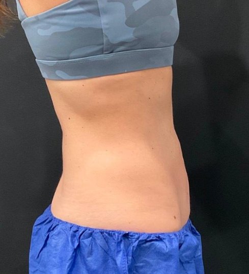 CoolSculpting Elite · lower abdomen after