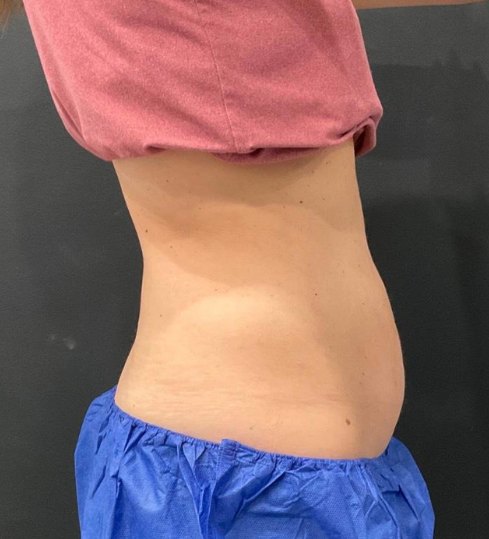 CoolSculpting Elite · lower abdomen before