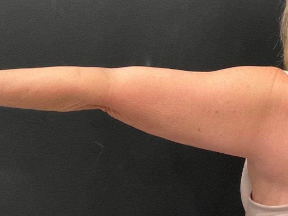 CoolSculpting Elite · upper arms after