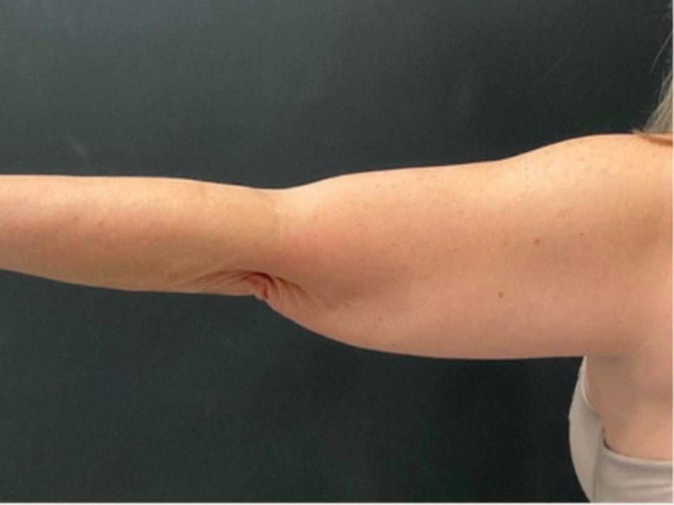 CoolSculpting Elite · upper arms before