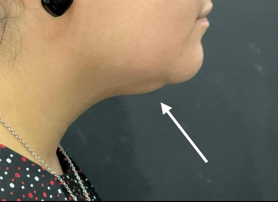 CoolSculpting Elite · chin after