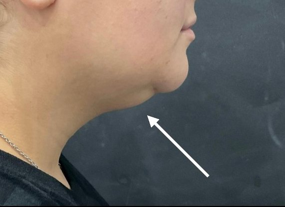 CoolSculpting Elite · chin before