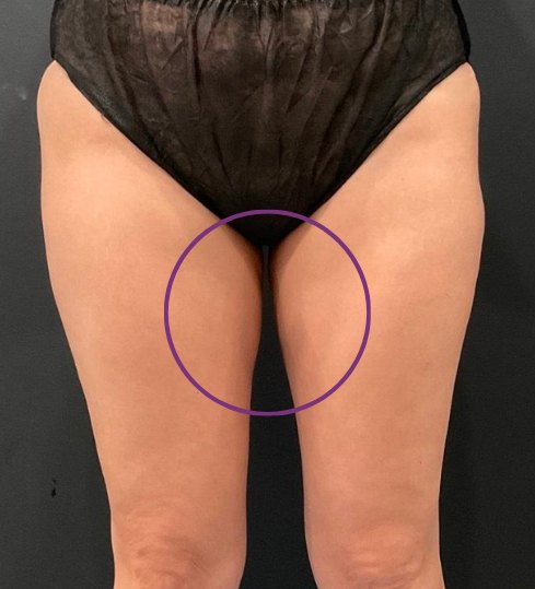 CoolSculpting Elite · inner thighs after