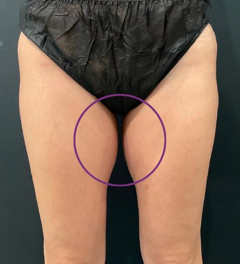 CoolSculpting Elite · inner thighs before