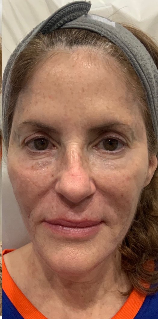 Dermal fillers · full face after