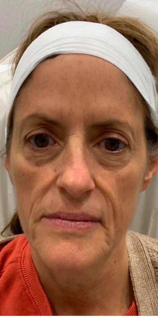 Dermal fillers · full face before