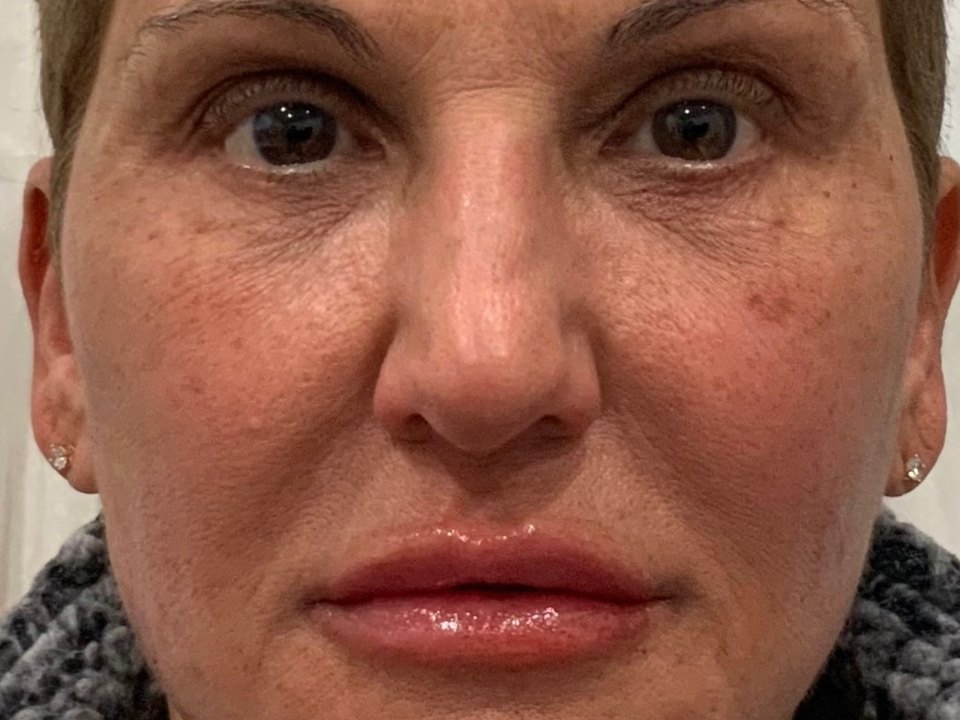 Filler · full face after