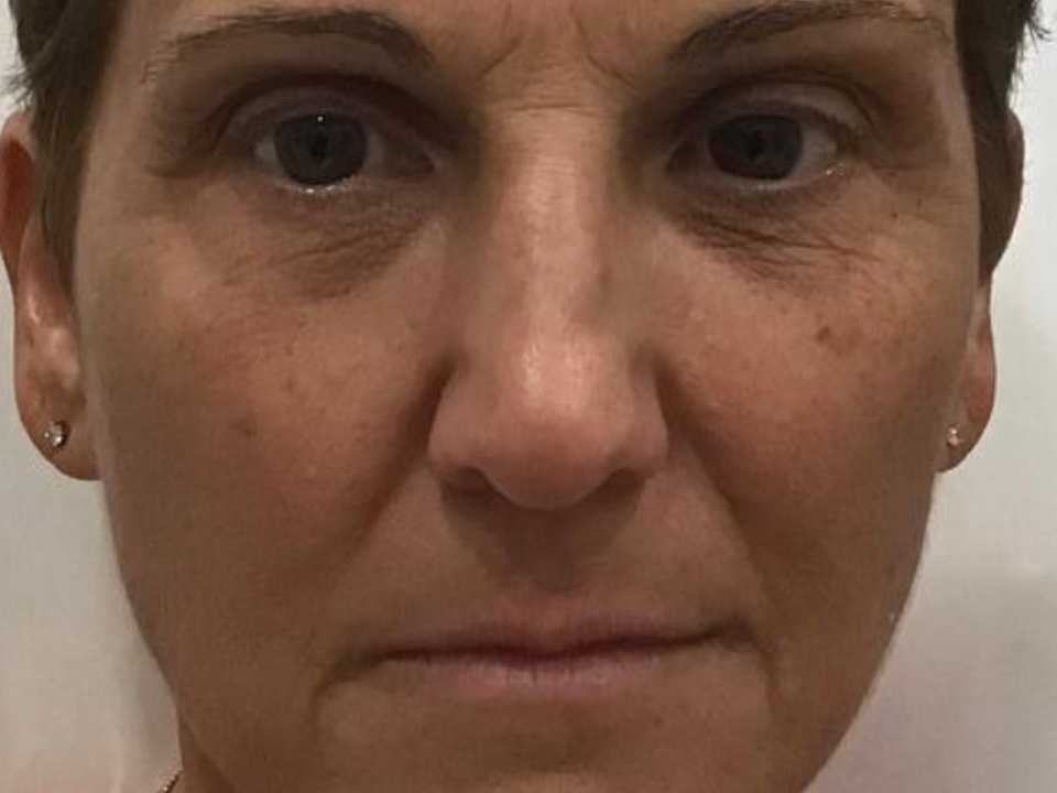 Filler · full face before