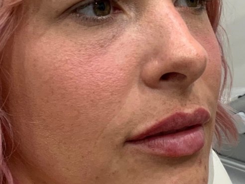 Juvéderm · lips after