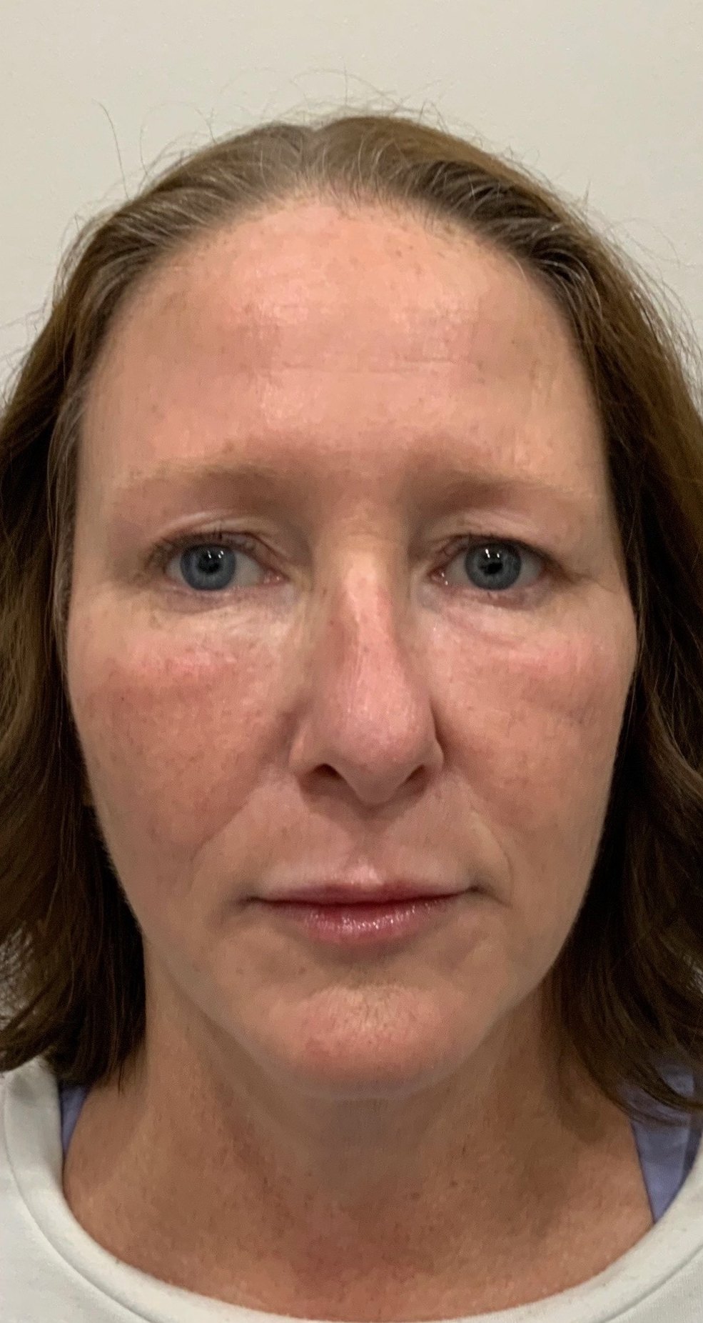 Filler, pigment & Botox · full face after