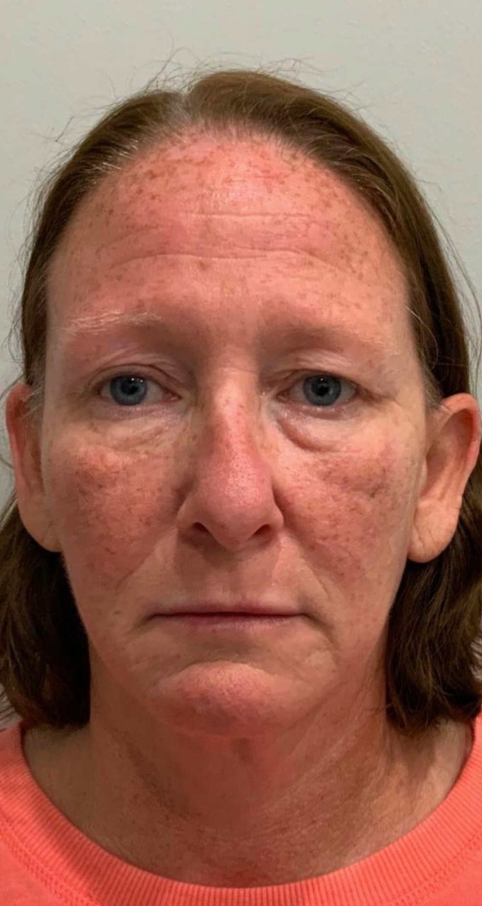 Filler, pigment & Botox · full face before