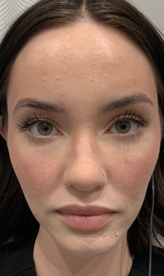 IPL photofacial · pigmentation after