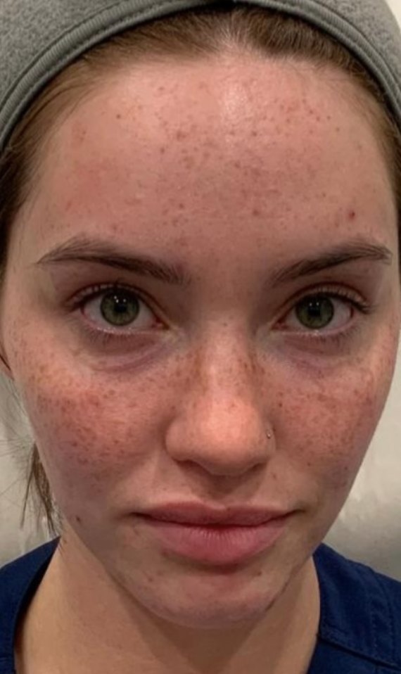 IPL photofacial · pigmentation before