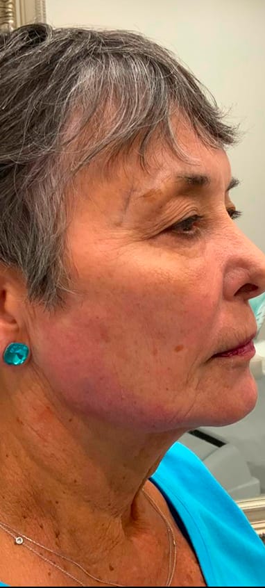 After jawline filler — lower face with more definition