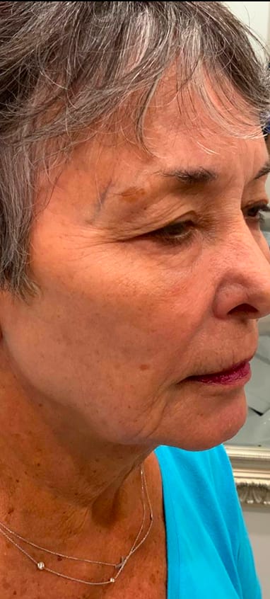 Before jawline filler — three-quarter view of the lower face