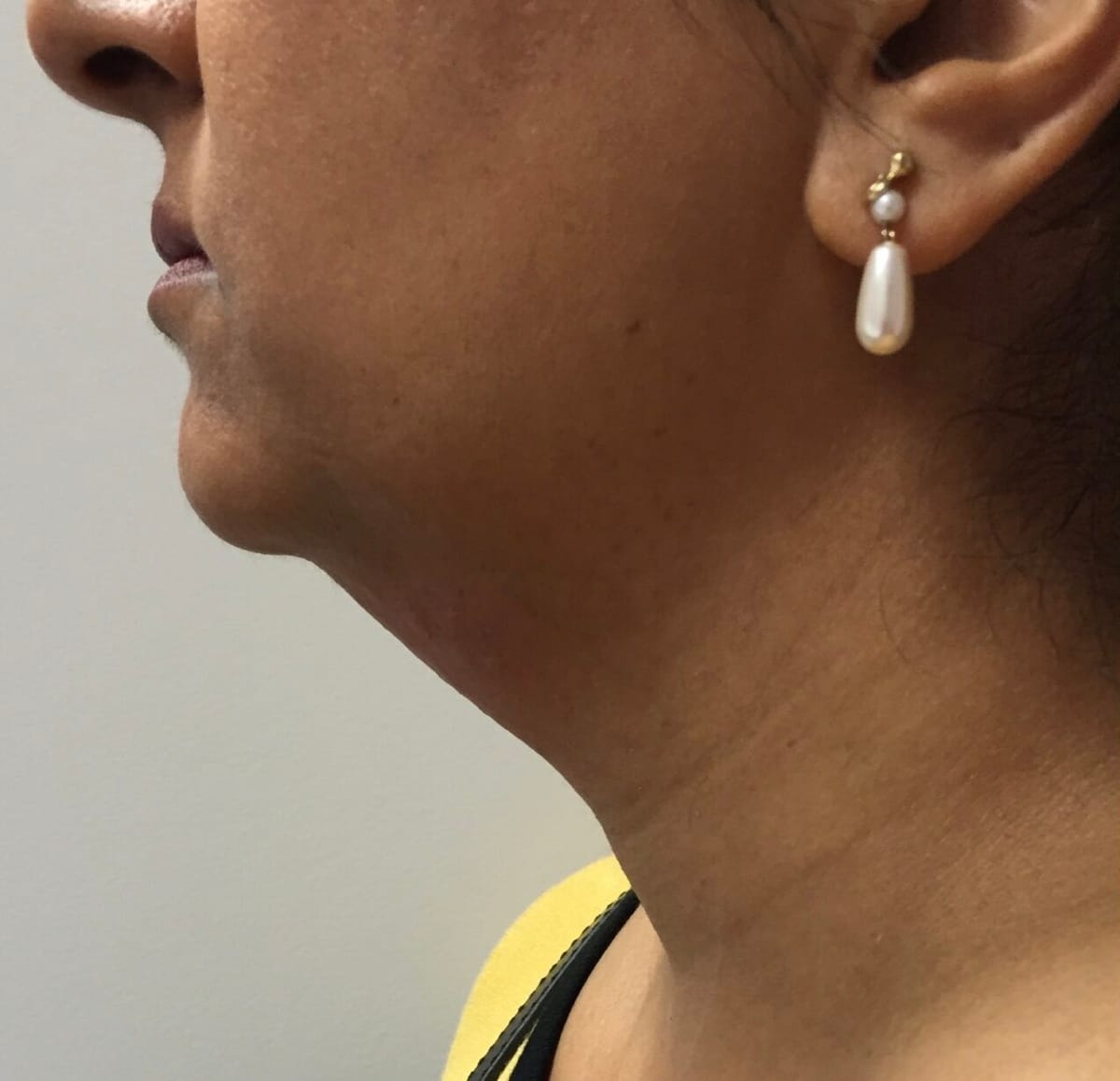 Before Kybella — profile showing submental fullness under the chin