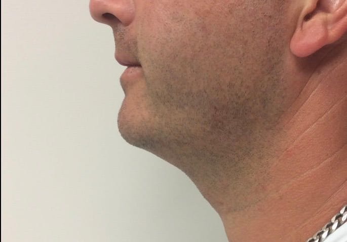 After Kybella — male patient, jawline and neck more defined