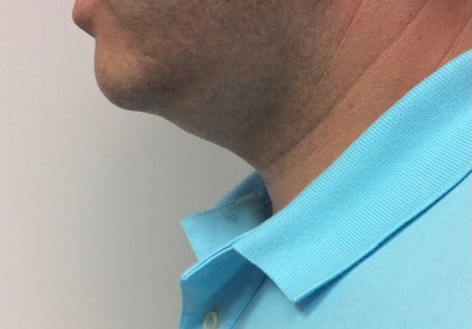Before Kybella — male patient, profile of the jawline and neck