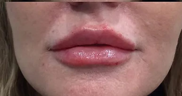 After lip filler — lips with added shape and hydration