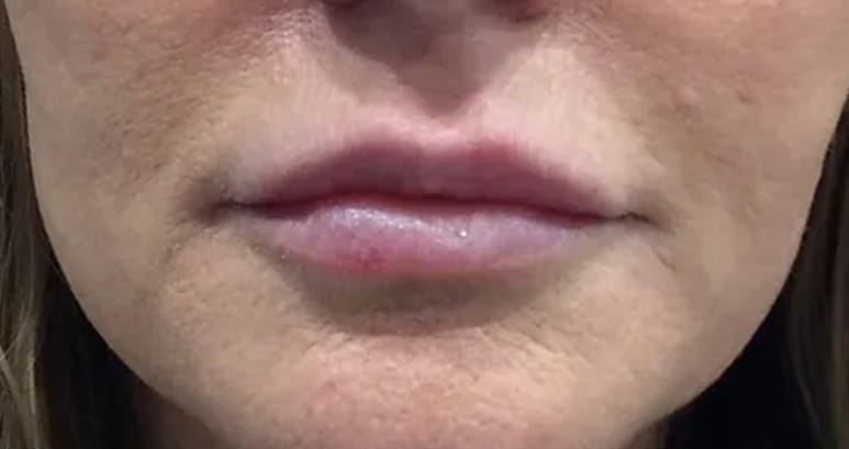 Before lip filler — close-up of the lips
