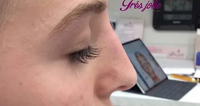 After liquid rhinoplasty — nose profile with the hump softened