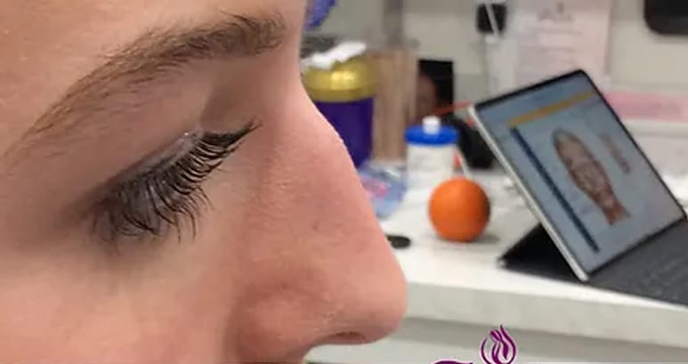 Before liquid rhinoplasty — nose profile showing a dorsal hump