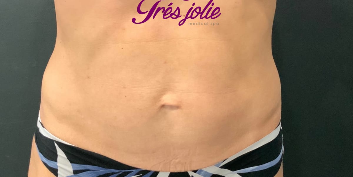 After skin tightening — firmer abdominal skin