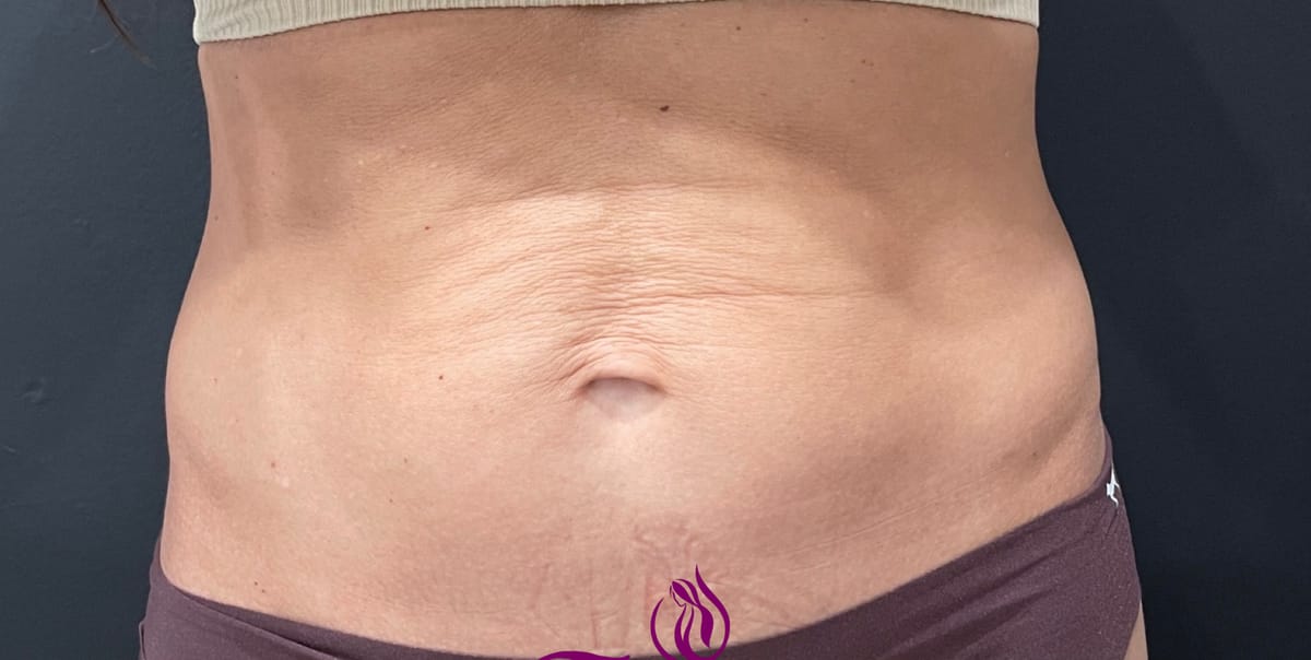Before skin tightening — abdominal skin laxity