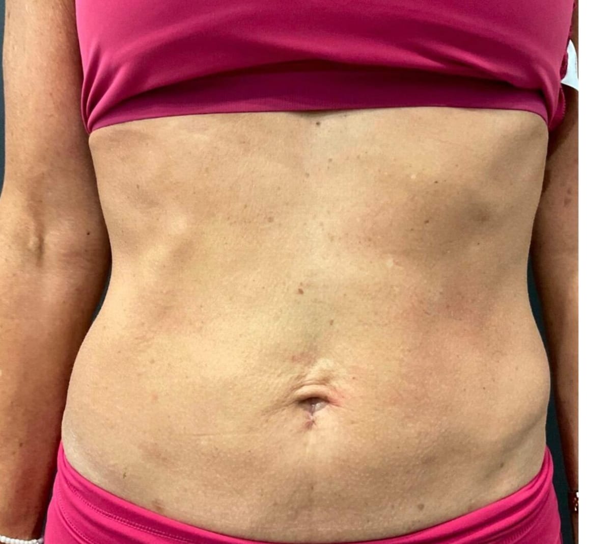 After Sofwave — tighter abdominal skin, front view