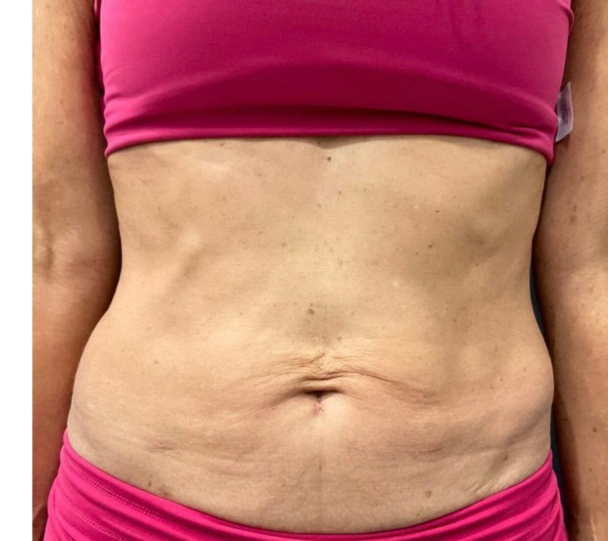 Before Sofwave — abdominal skin laxity, front view