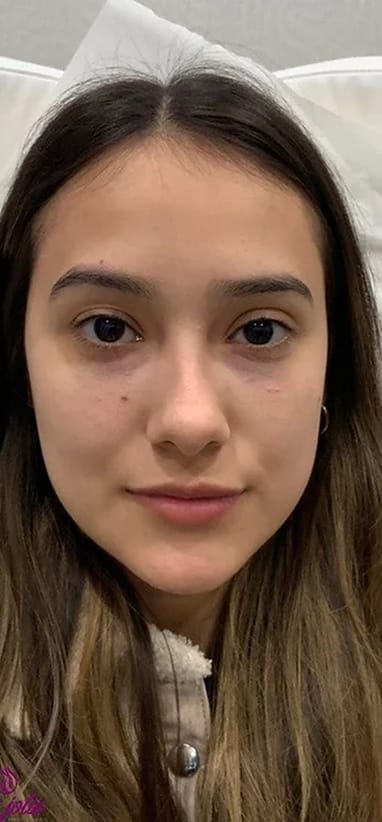 After under-eye filler — tear trough smoothed