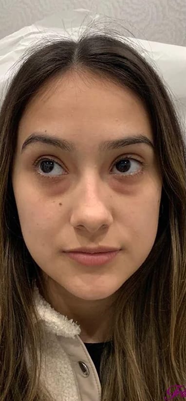 Before under-eye filler — tear-trough hollowing and shadow