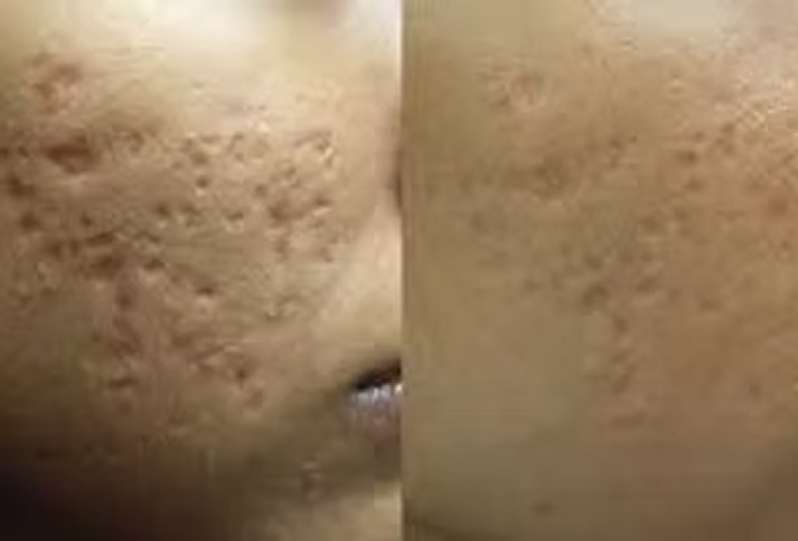 Fractional Skin Resurfacing & Tightening