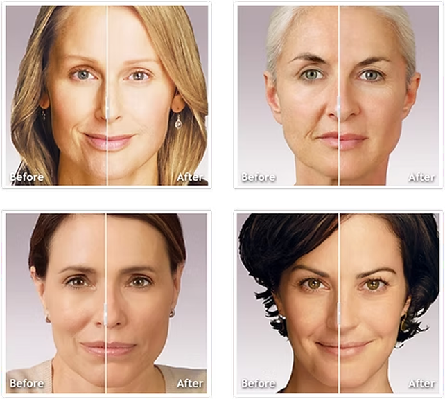 Juvederm