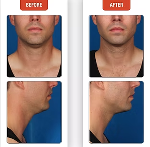 Kybella