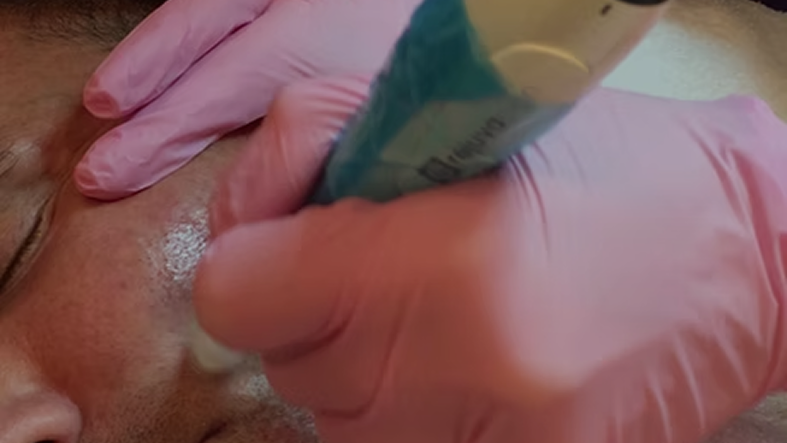 Microneedling