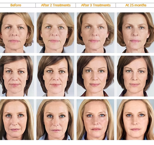 Sculptra & Radiesse