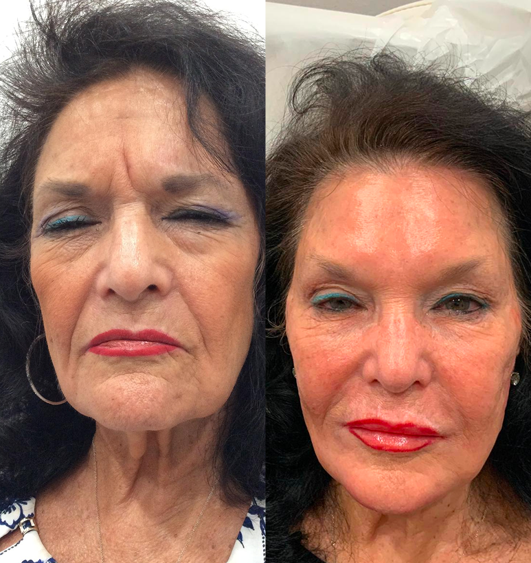 Full Face Treatment